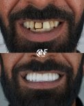 Vorher-nachher-Ergebnis All-on-6 Zahnimplantate bei Nifa Dent International, Lächeln restauriert