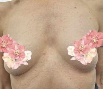 before-after photo breast-augmentation
