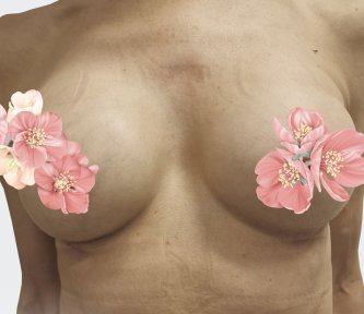 before-after photo breast-augmentation