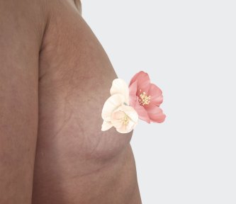 before-after photo breast-augmentation
