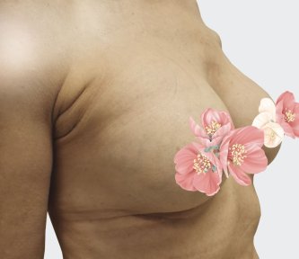 before-after photo breast-augmentation