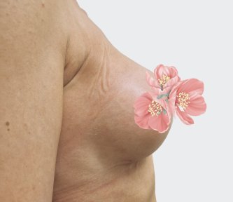 before-after photo breast-augmentation