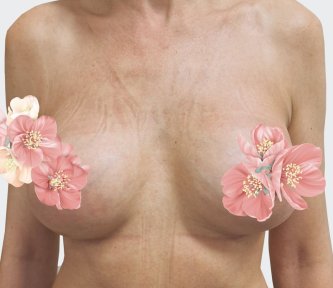 before-after photo breast-augmentation
