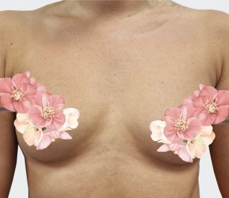 before-after photo breast-augmentation