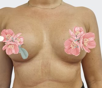 before-after photo breast-augmentation