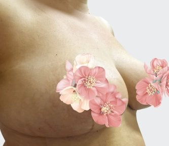 before-after photo breast-reduction