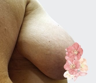 before-after photo breast-reduction