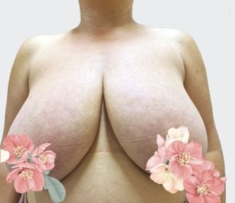 before-after photo breast-reduction