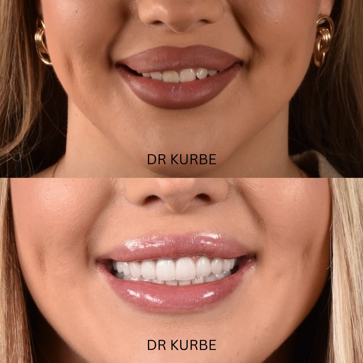 نتائج قبل وبعد ابتسامة هوليود في عيادة Dr Kurbe – تحول واضح للابتسامة