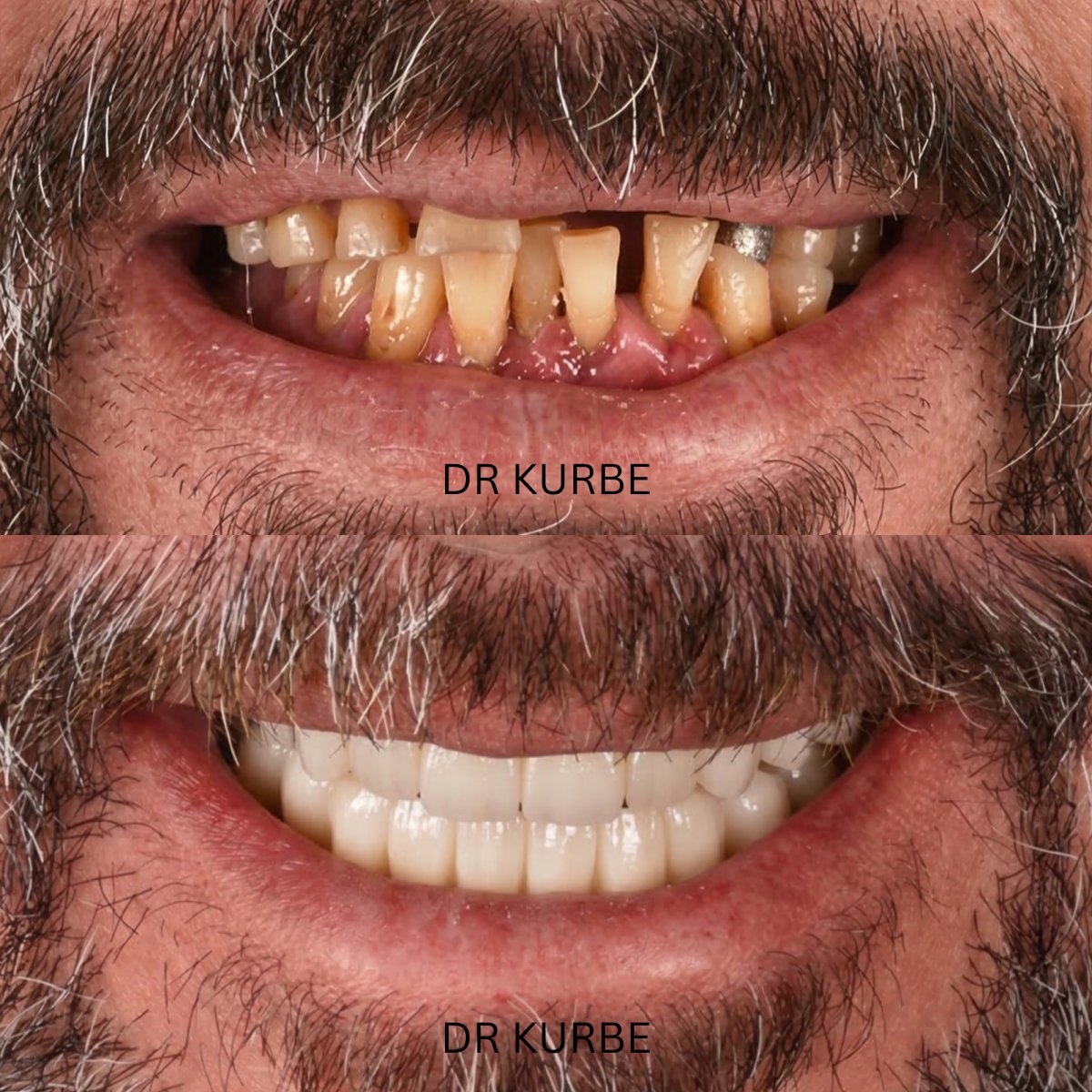 Resultado antes y después de implantes dentales All-on-4 por Dr Kurbe – sonrisa restaurada