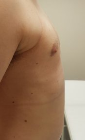 before-after photo gynecomastia-surgery