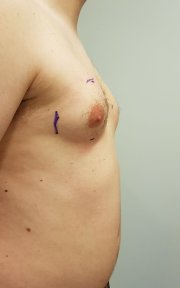 before-after photo gynecomastia-surgery