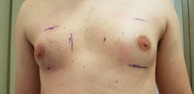 before-after photo gynecomastia-surgery