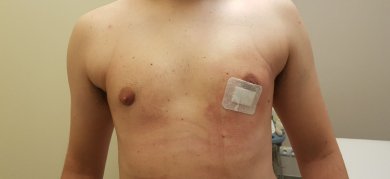 before-after photo gynecomastia-surgery
