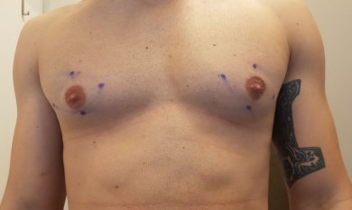 before-after photo gynecomastia-surgery