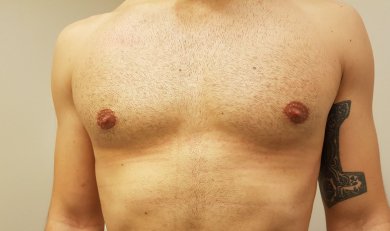 before-after photo gynecomastia-surgery