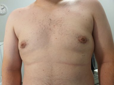 before-after photo gynecomastia-surgery