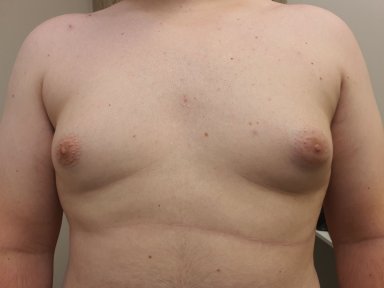 before-after photo gynecomastia-surgery