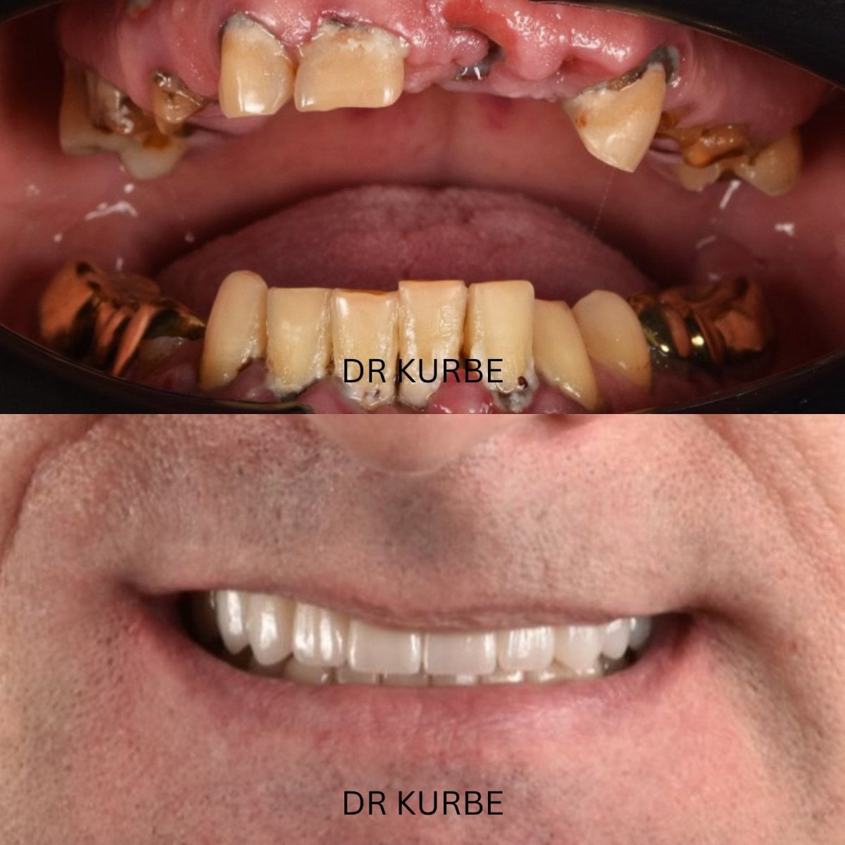 نتيجة قبل وبعد زراعة الأسنان All-on-4 في عيادة Dr Kurbe – استعادة الابتسامة الكاملة