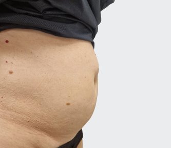before-after photo abdominoplasty