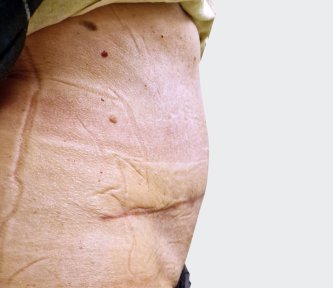 before-after photo abdominoplasty
