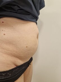 before-after photo abdominoplasty