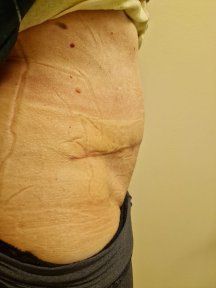 before-after photo abdominoplasty