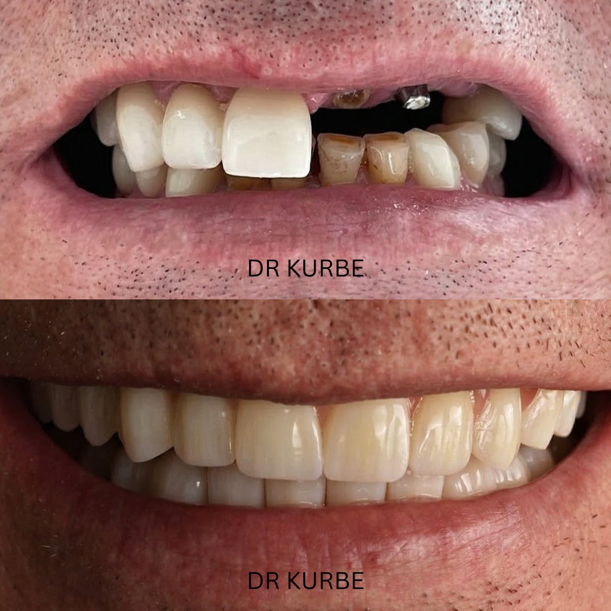 Antes y después de implante dental con corona en clínica Dr Kurbe – resultado sonrisa