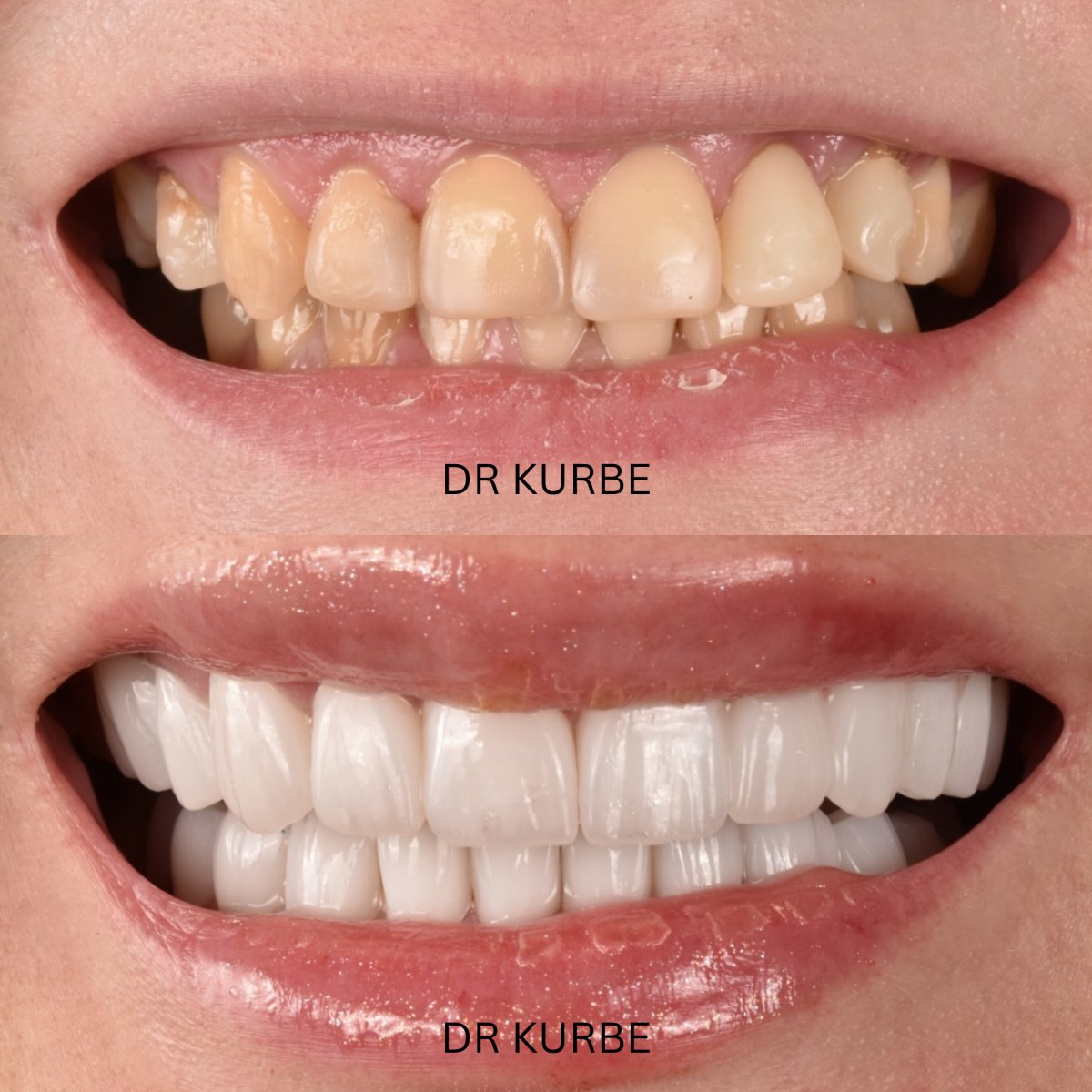 نتائج قبل وبعد ابتسامة هوليود في عيادة Dr Kurbe – تحول القشور الخزفية