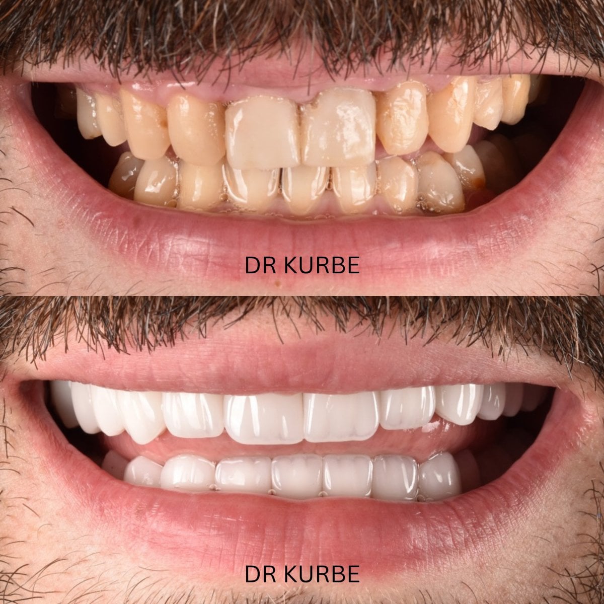 Resultados de antes y después de Hollywood Smile en Dr Kurbe – transformación con carillas