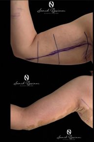 before-after photo abdominoplasty
