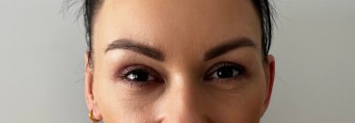 Blepharoplasty result – rejuvenated upper eyelids after eyelid correction procedure