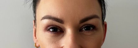 Blepharoplasty result – rejuvenated upper eyelids after eyelid correction procedure
