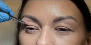 Blepharoplasty procedure on upper eyelid, eyelid correction treatment result at clinic