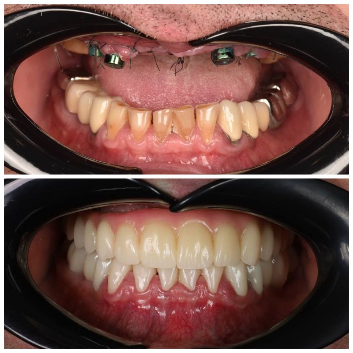 نتيجة قبل وبعد زراعة الأسنان All-on-4 في عيادة Dental Clinic Dynasty Stomatology كراكوف