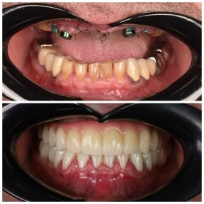 before-after photo all-on-4-dental-implants