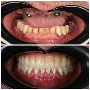 before-after photo dental-implant