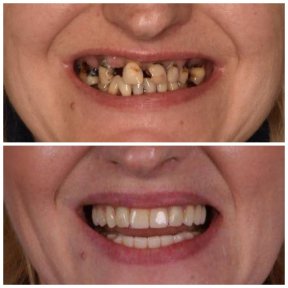 before-after photo dental-implant
