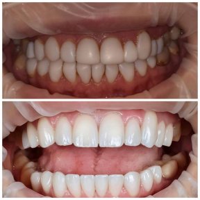 before-after photo installation-of-a-veneer