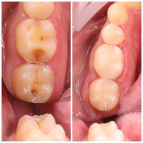 before-after photo dental-bonding