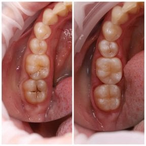 before-after photo dental-bonding