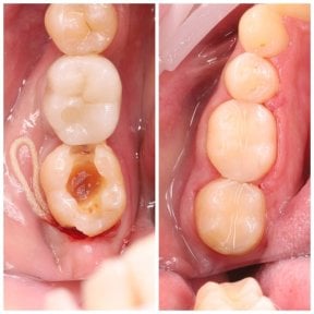 before-after photo root-canal-treatment