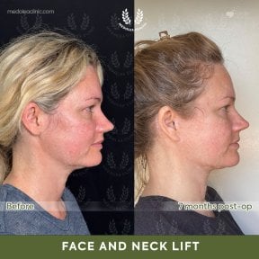 before-after photo deep-plane-facelift