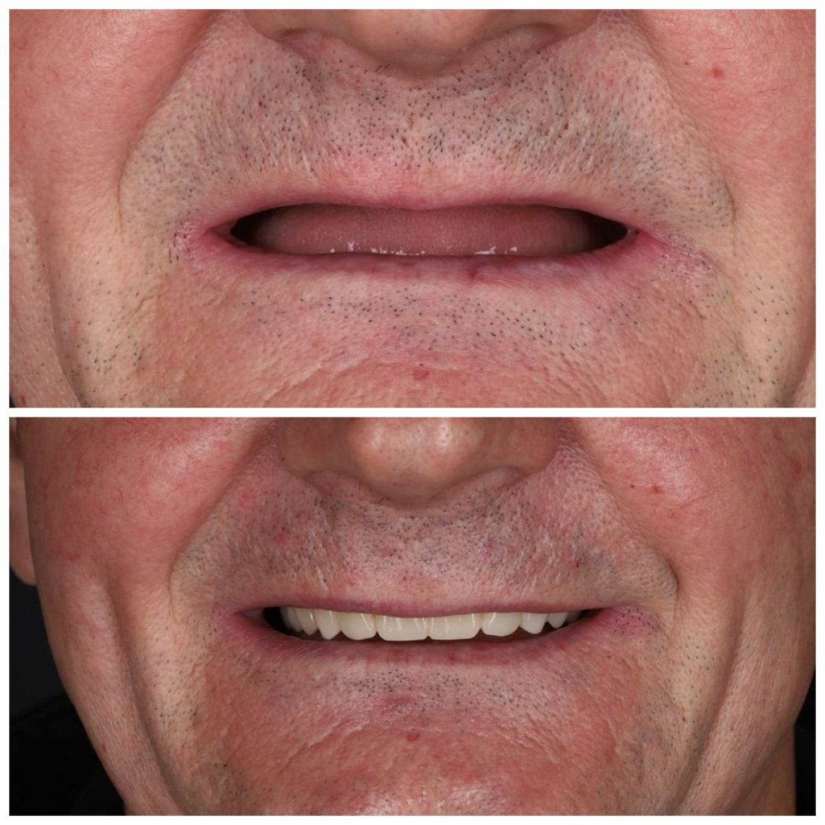 Resultados antes y después de dentadura en Dental Clinic Dynasty Stomatology en Cracovia, sonrisa mejorada