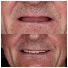 before-after photo denture