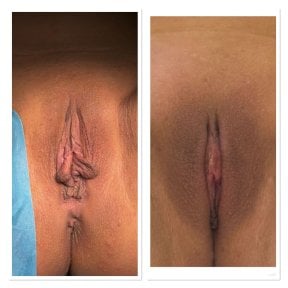 before-after photo labiaplasty