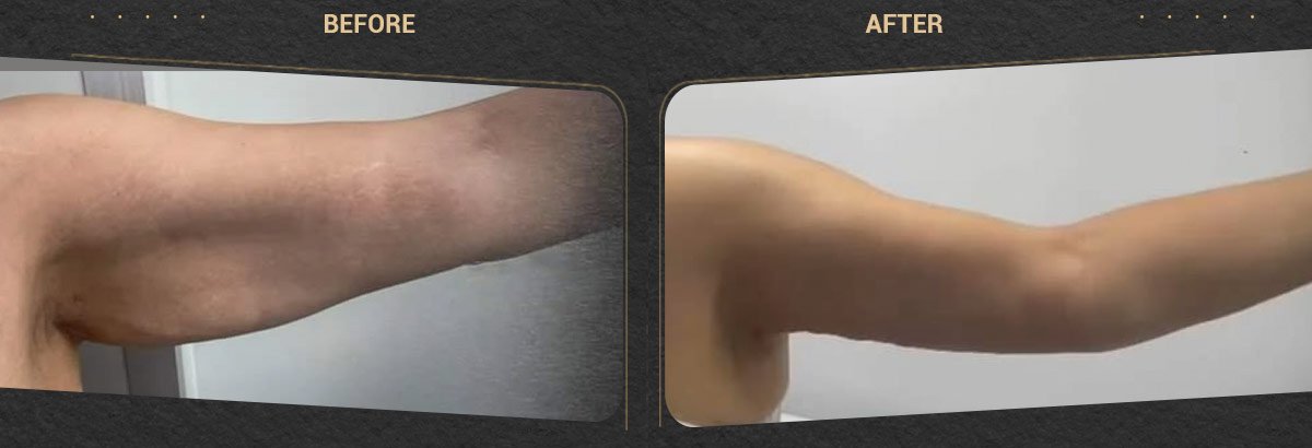 Resultados antes y después de lifting de brazos – contorno y firmeza mejorados