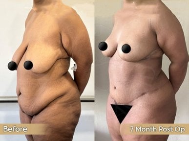 before-after photo 360-liposuction