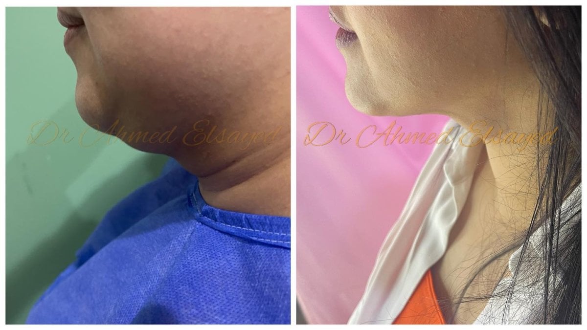 Resultados de lifting de cuello antes y después con Dr. Ahmed Elsayed – mandíbula definida