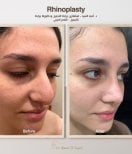 نتائج عملية تجميل الأنف قبل وبعد مع د. أحمد السيد – تحسين شكل الأنف